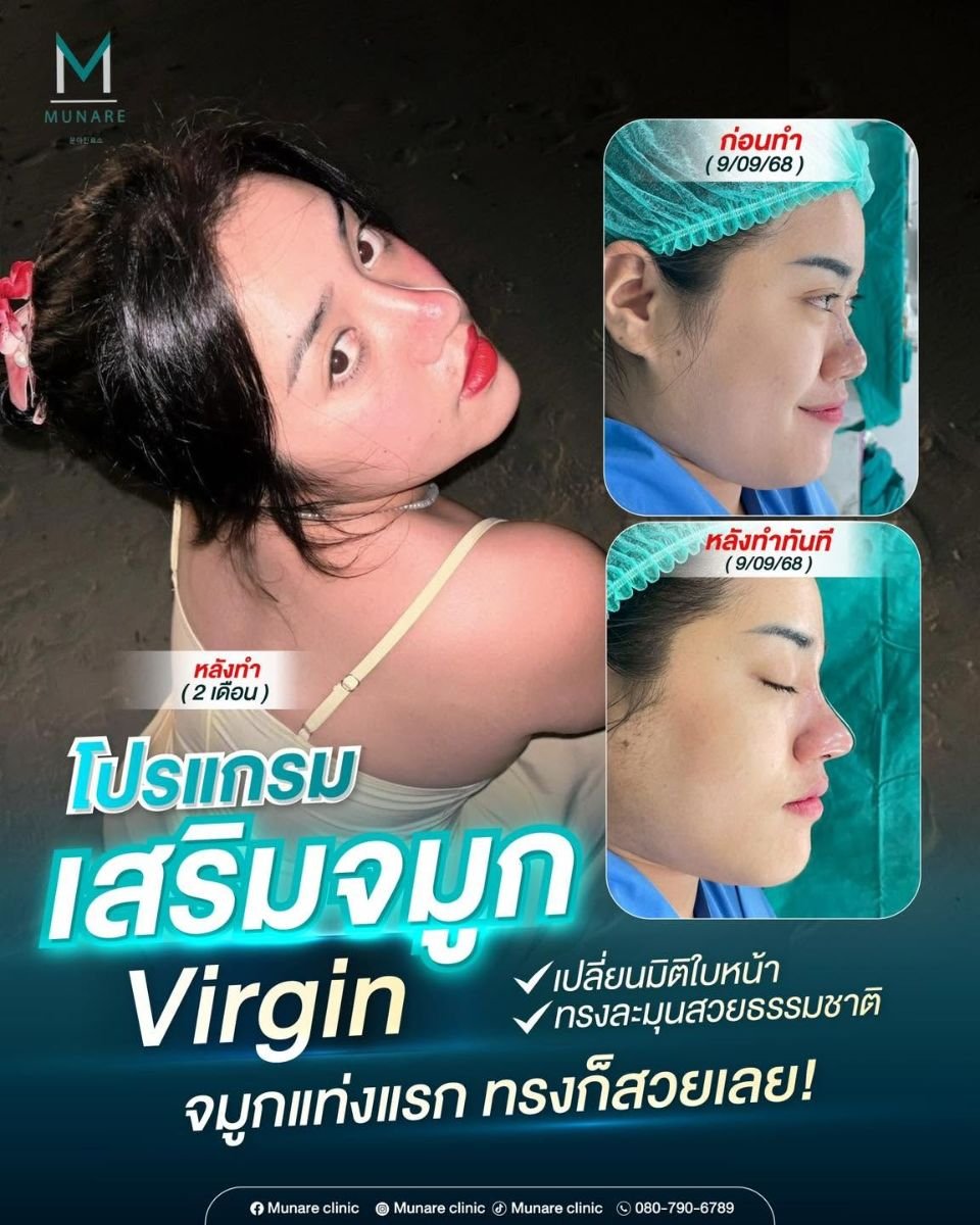 Efekty przed i po rhinoplastyce w Munare Clinic Chiangmai, naturalne wymodelowanie nosa