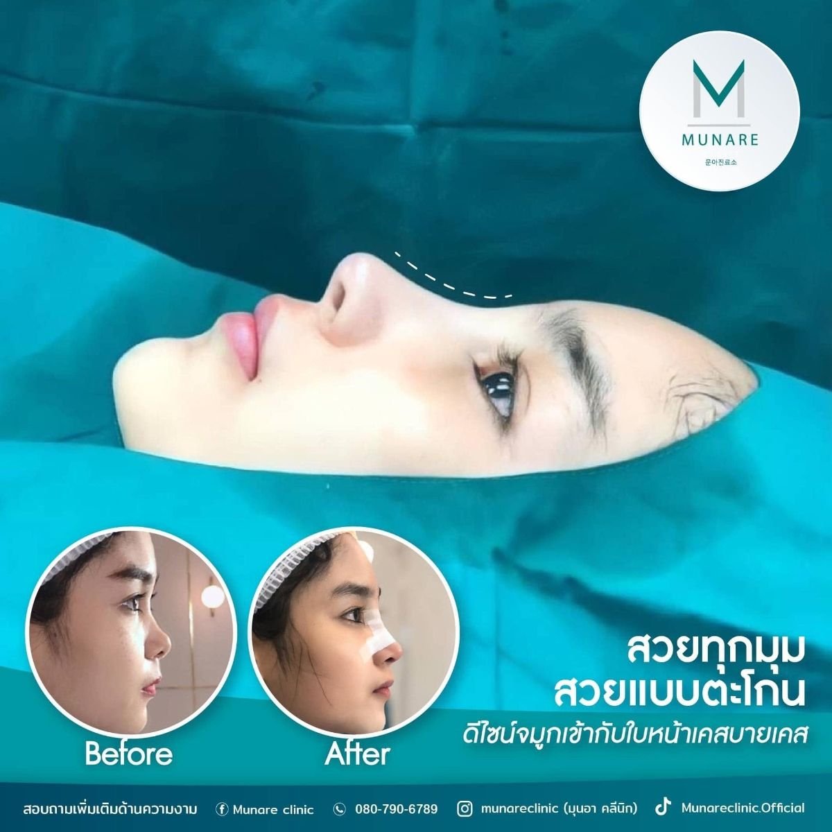Before and after rhinoplasty results at Munare Clinic Chiangmai, improved nose profile