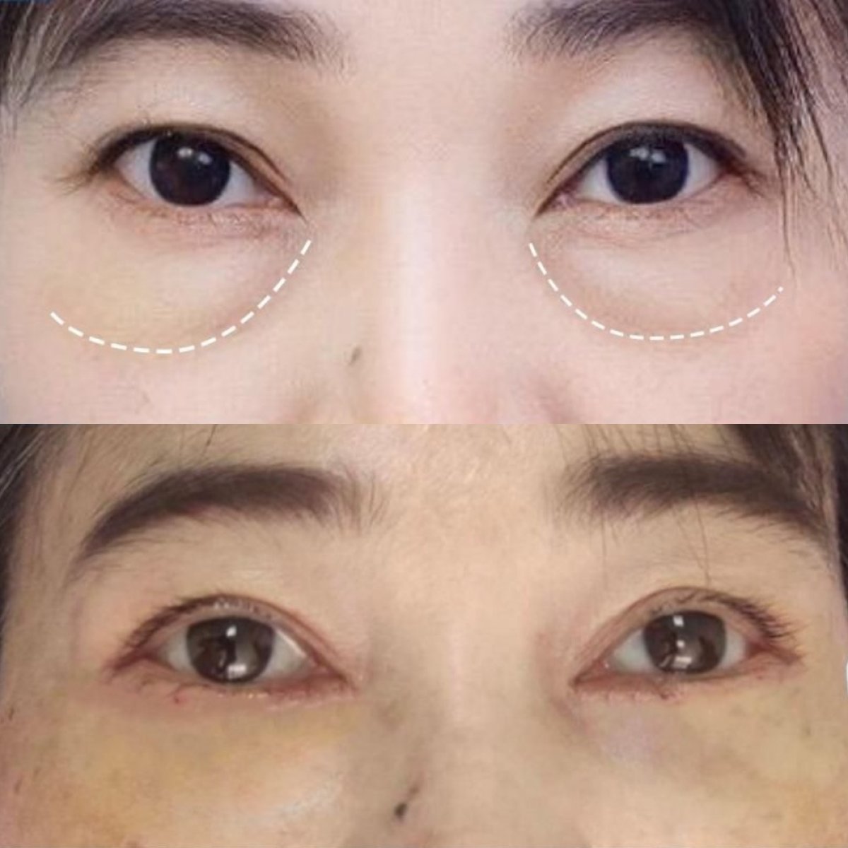 Before and after blepharoplasty results at Asia Cosmetic Hospital, eyelid correction procedure