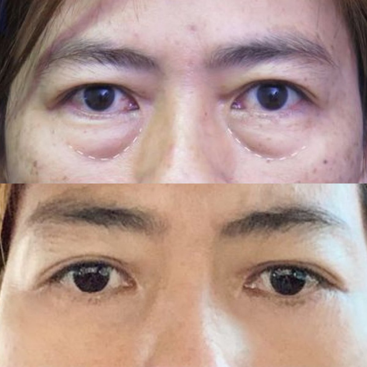 Blepharoplasty before and after results at Asia Cosmetic Hospital, eyelid correction improvement