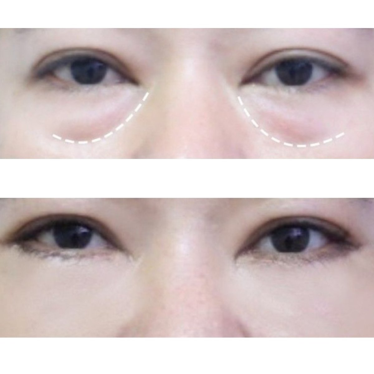 Before and after blepharoplasty results at Asia Cosmetic Hospital, eyelid correction procedure