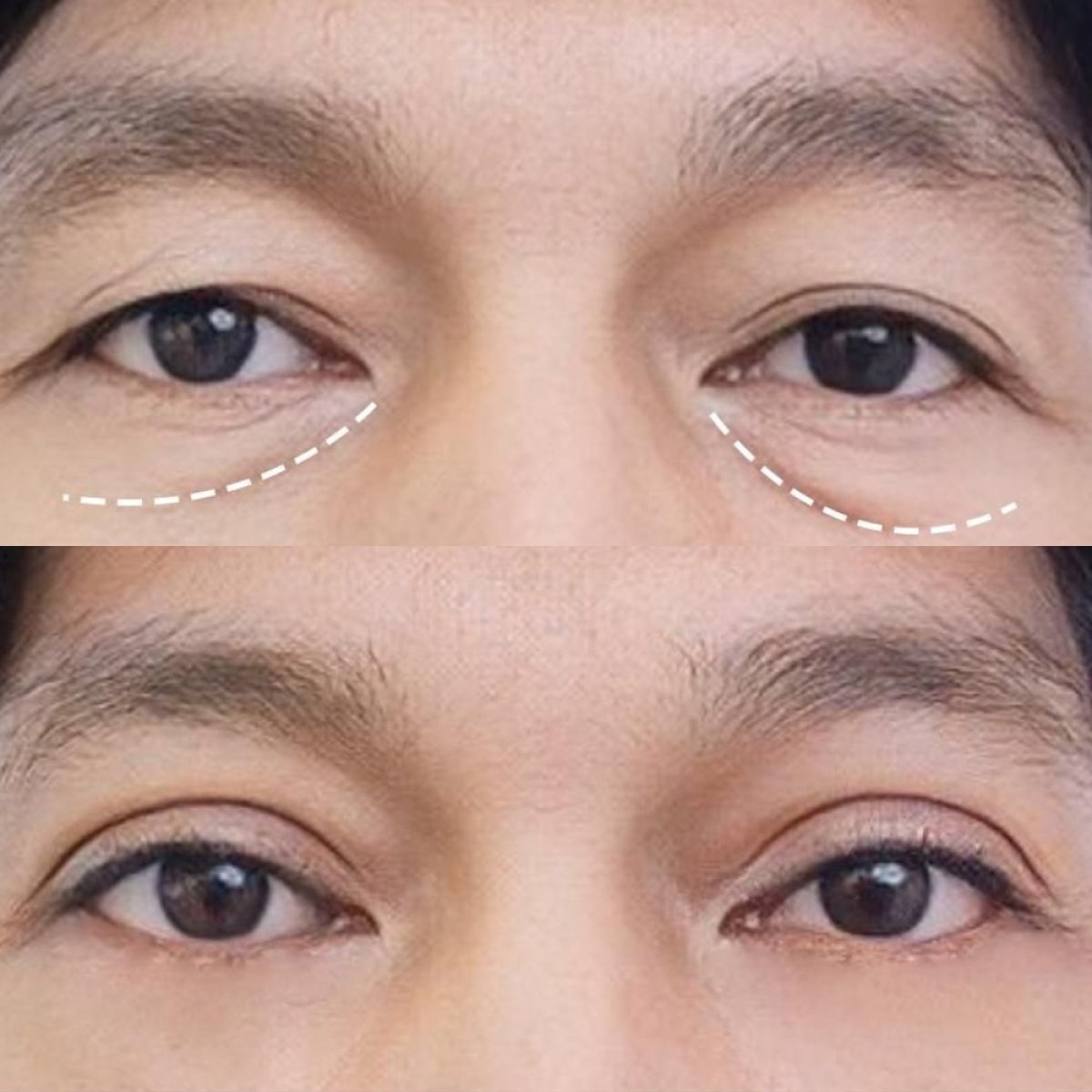 Результаты блефаропластики до и после в Asia Cosmetic Hospital, коррекция век