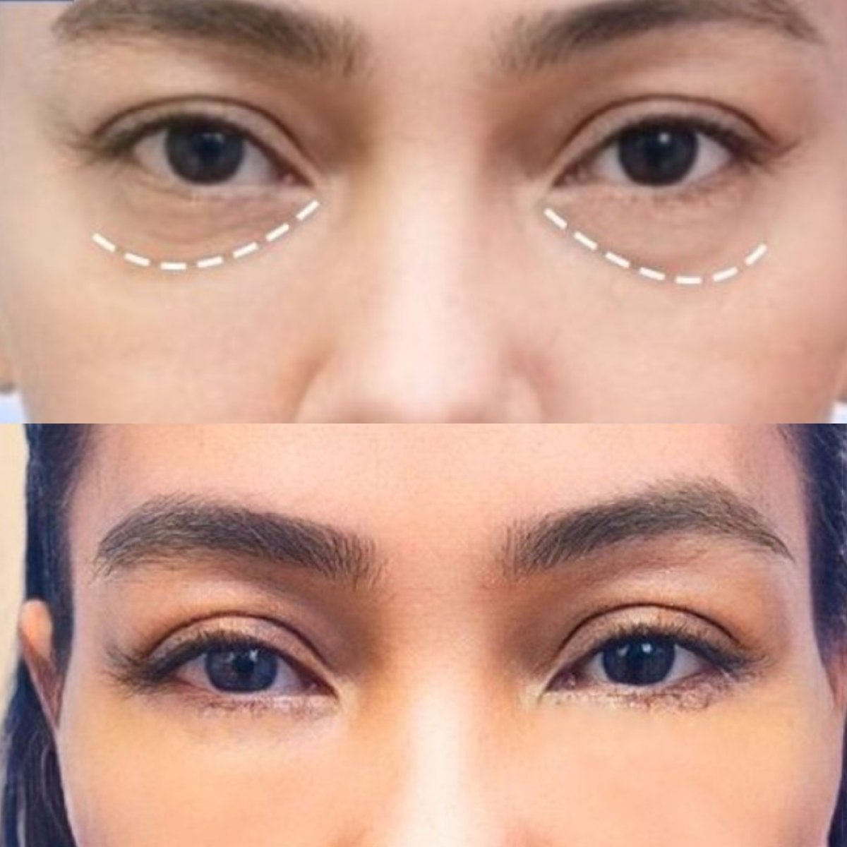 Before and after blepharoplasty results at Asia Cosmetic Hospital, eyelid correction procedure