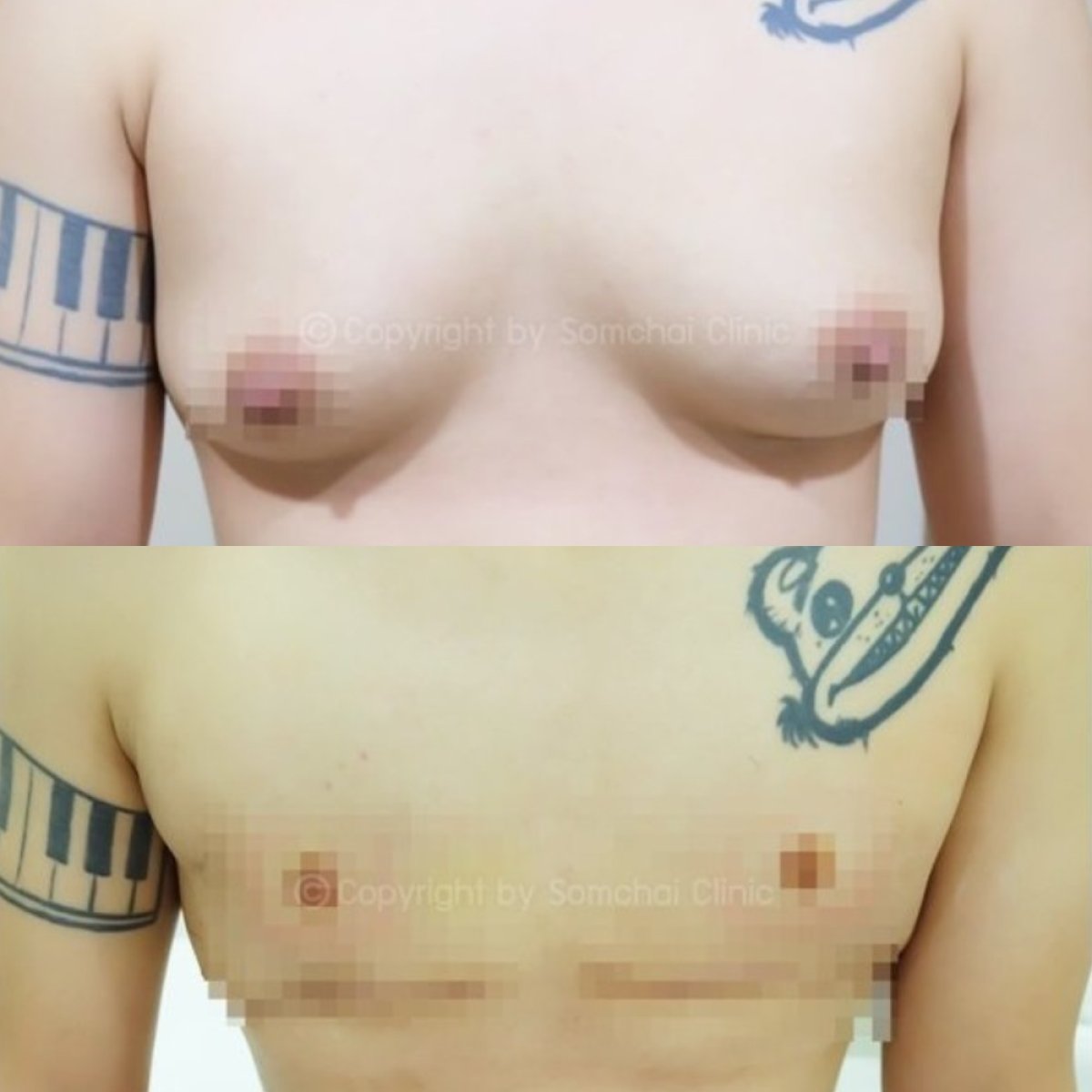 Résultats avant/après top surgery à la Somchai Clinic – masculinisation du torse