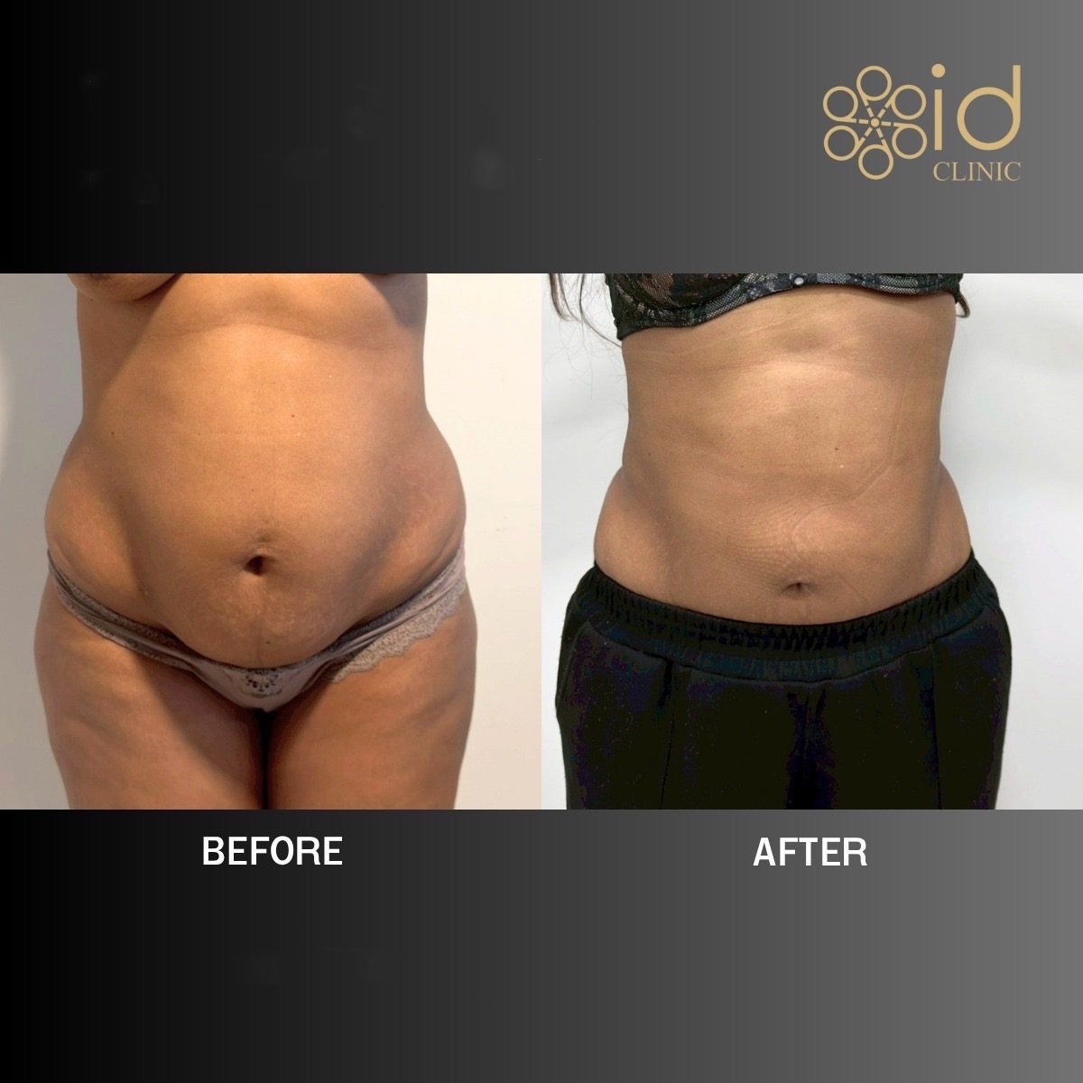 Before and after liposuction results at ID Clinic Bangkok, visible abdominal contour improvement