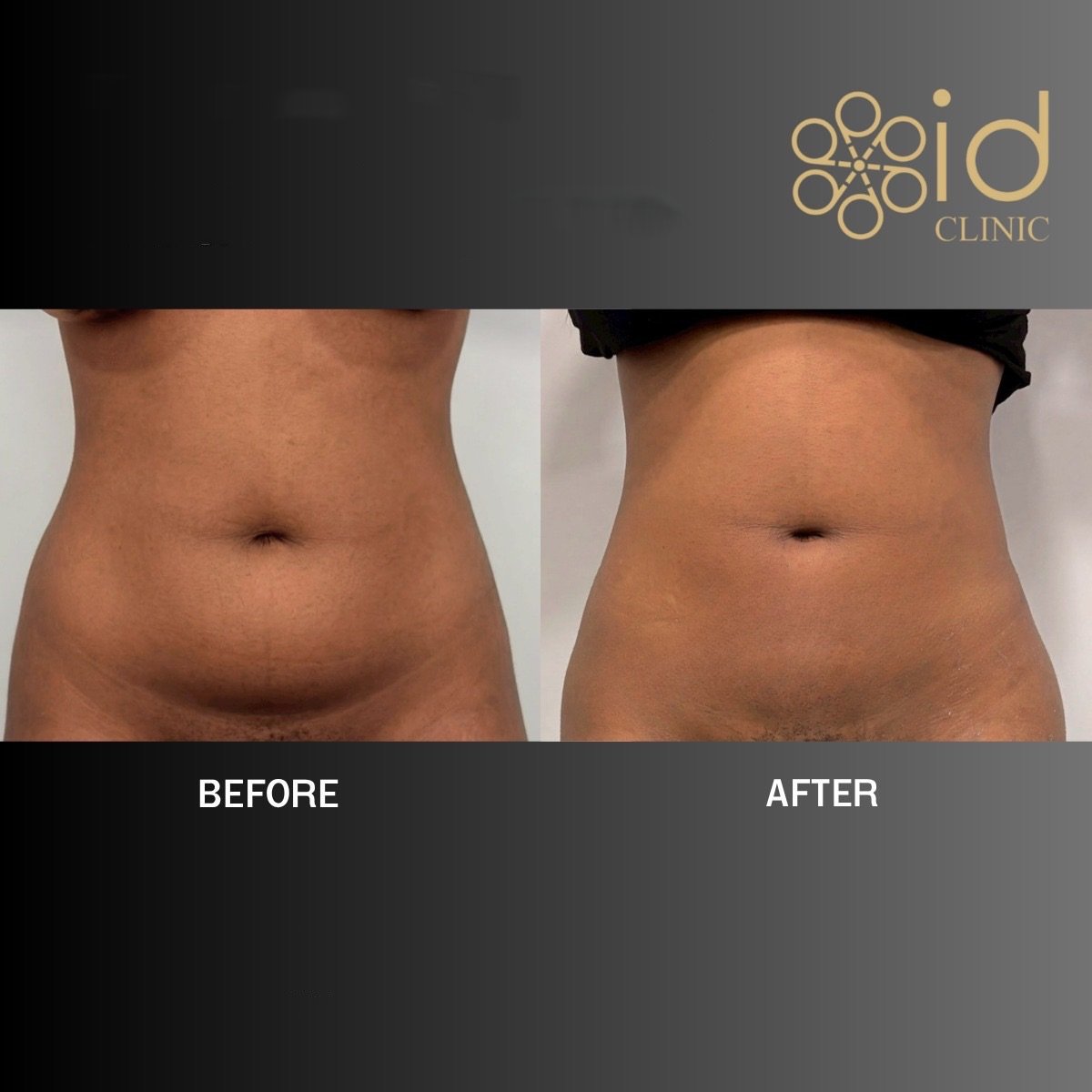 Before and after liposuction results at ID Clinic Bangkok, visible abdominal contour improvement