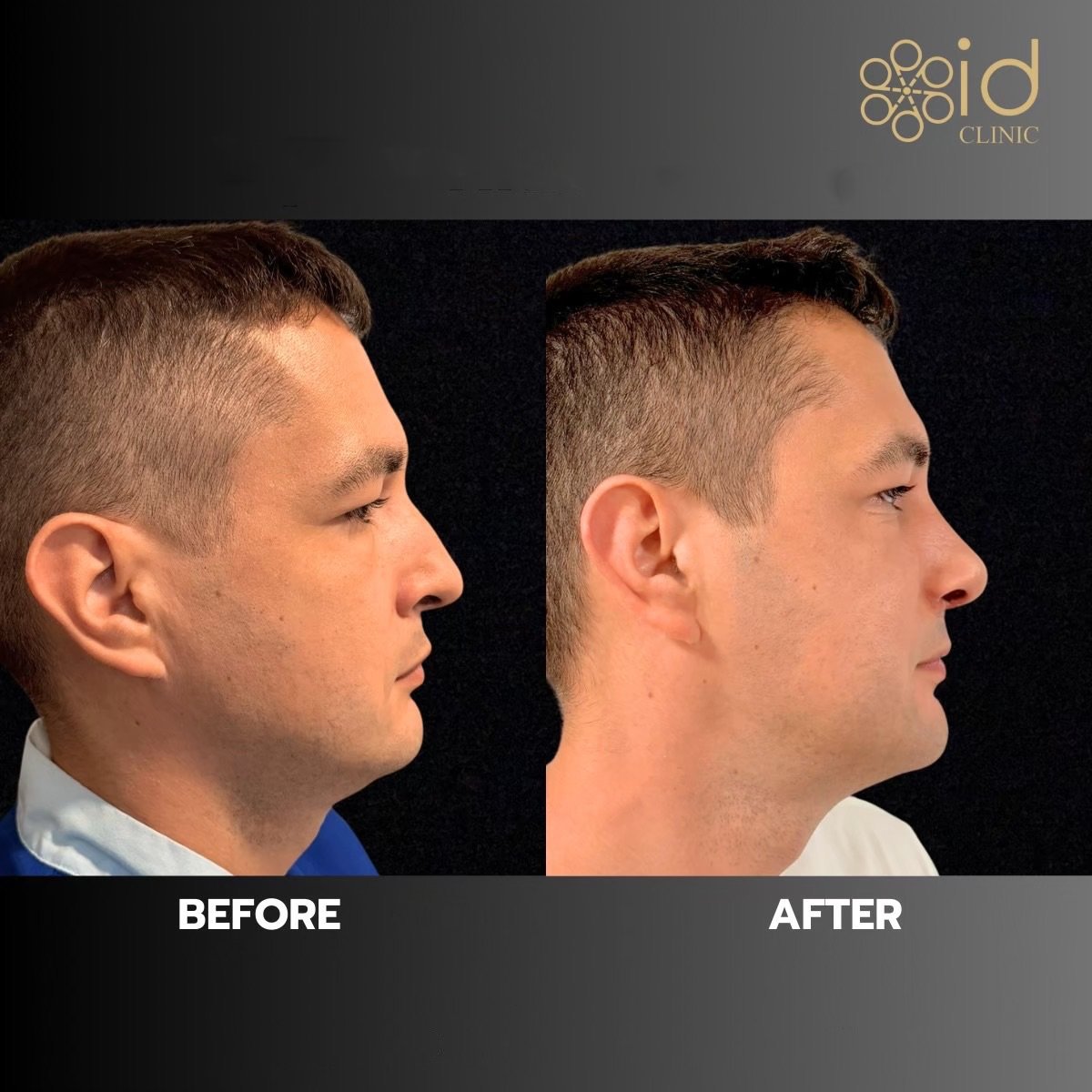 Before and after rhinoplasty results at ID Clinic Bangkok, improved nose profile in male patient