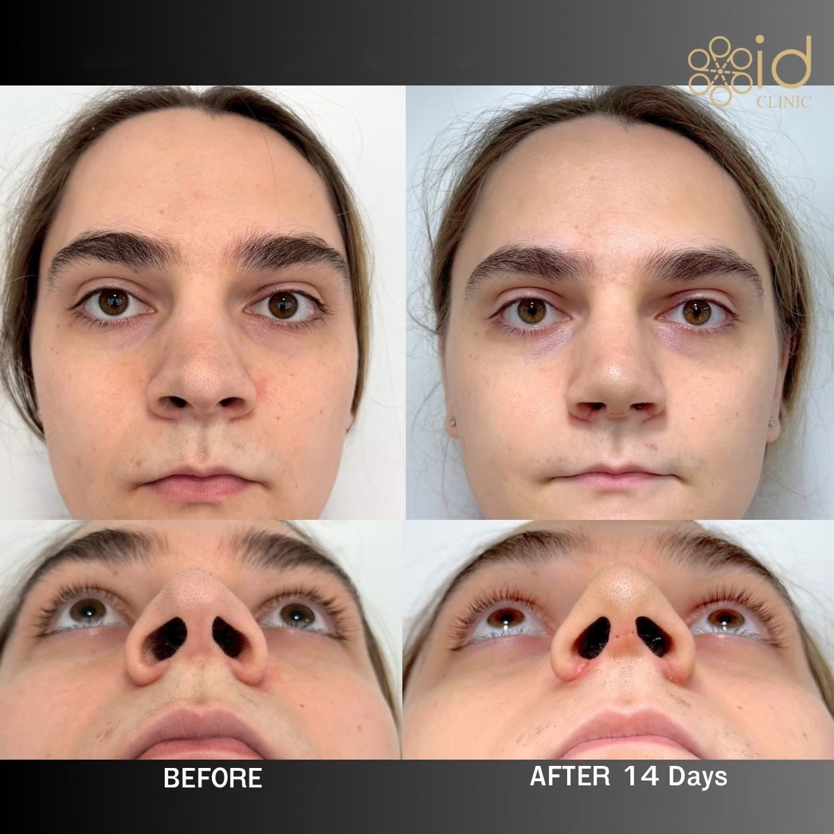 Before and after rhinoplasty results at ID Clinic Bangkok, nose reshaping after 14 days