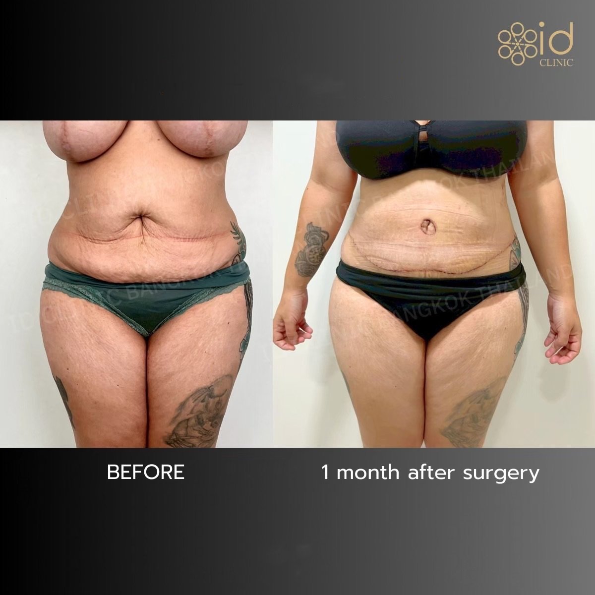 Before and after Vaser liposuction results at ID Clinic Bangkok, visible body contouring improvement
