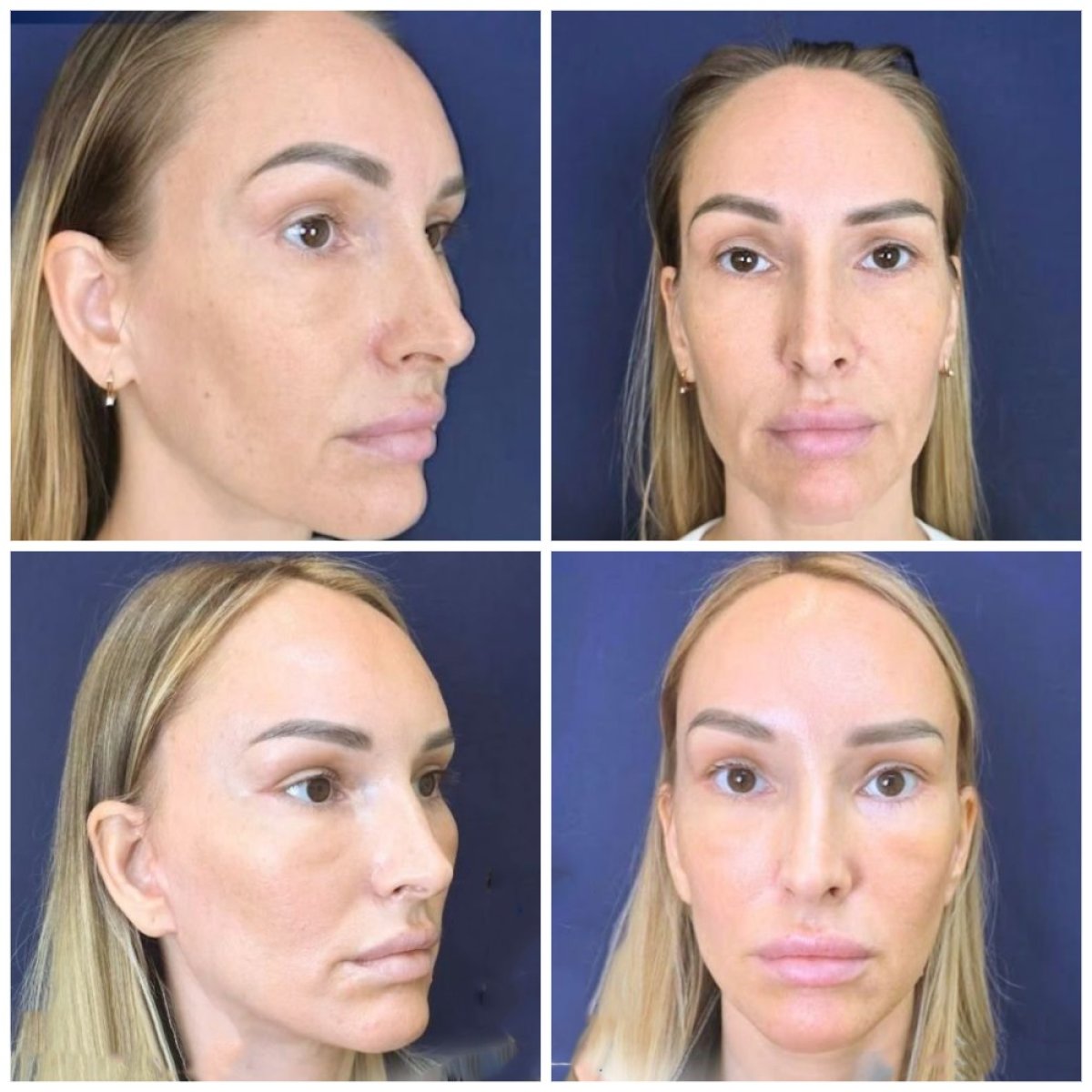 Resultados de lifting facial antes y después en Intrarat Hospital – rejuvenecimiento visible