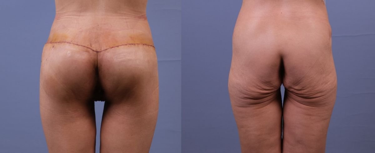 Lower body lift before and after results at Dr. Safa Manav Clinic, improved body contour