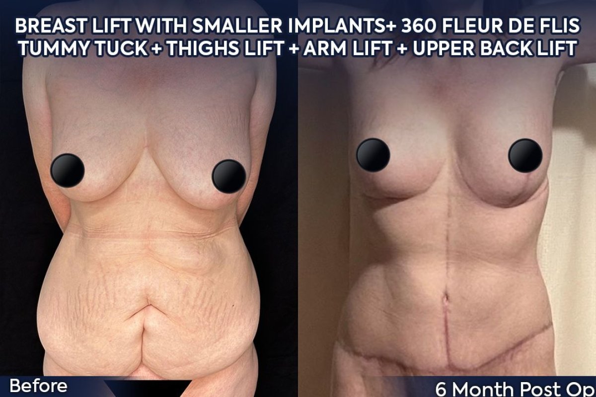 Before and after lower body lift, tummy tuck, and breast lift results at Dr. Safa Manav Clinic