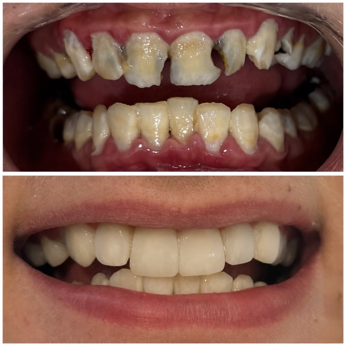 Resultados antes y después de restauración dental (bonding) en Spanderashvili Dental Clinic