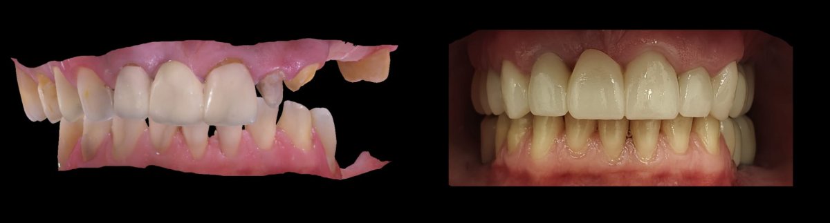 Before and after tooth reshaping results at Dentium Implant Center – improved tooth alignment