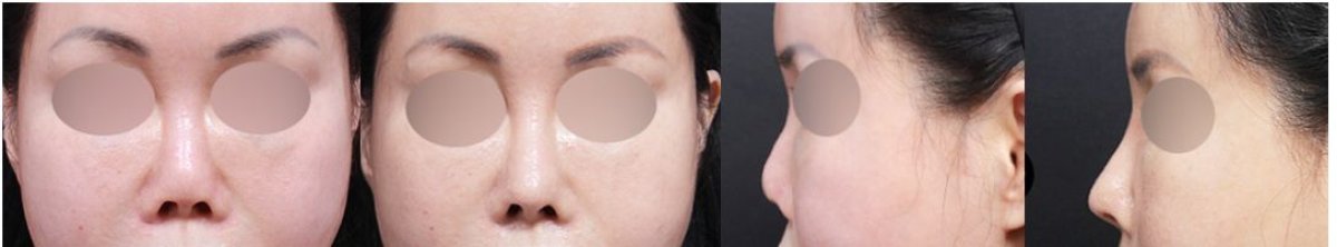Результаты ринопластики до и после в VG Plastic Surgery, улучшенная форма носа и профиль