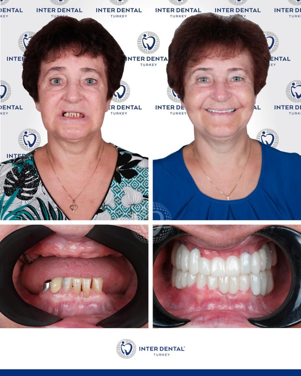 Before and after dental implant results at Inter Dental Turkey – restored smile and teeth