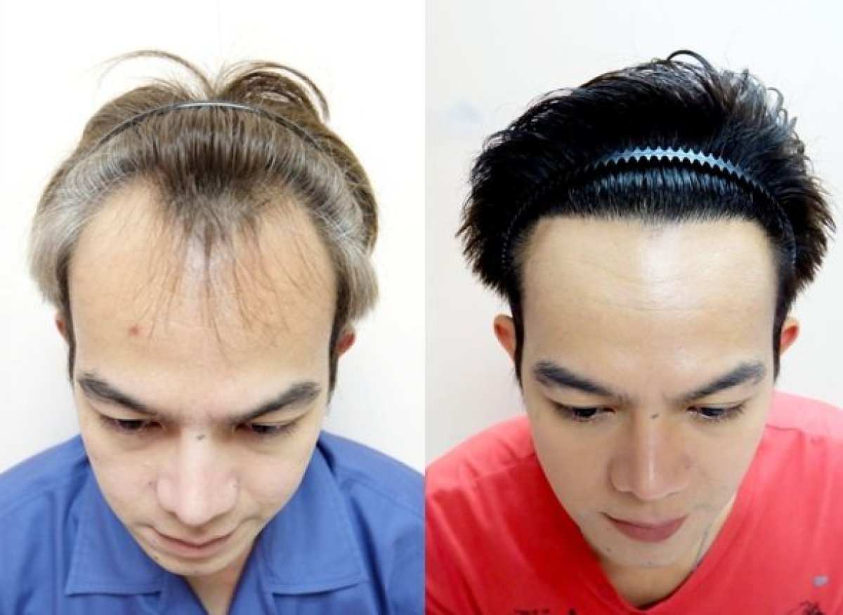 Результат пересадки волос FUE до и после в Dr.Orn Clinic : Medical Hair, улучшенная линия волос