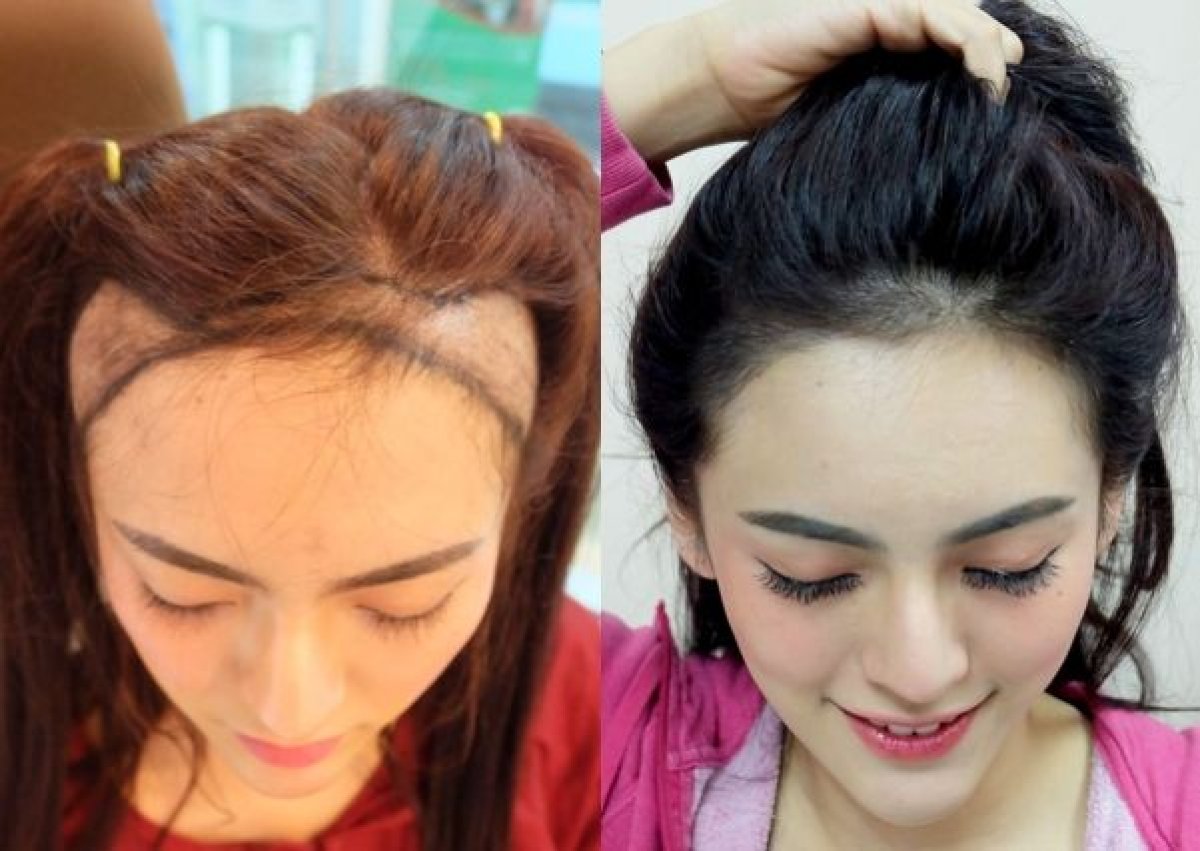 Antes y después de trasplante capilar FUE en Dr.Orn Clinic : Medical Hair, resultado línea capilar