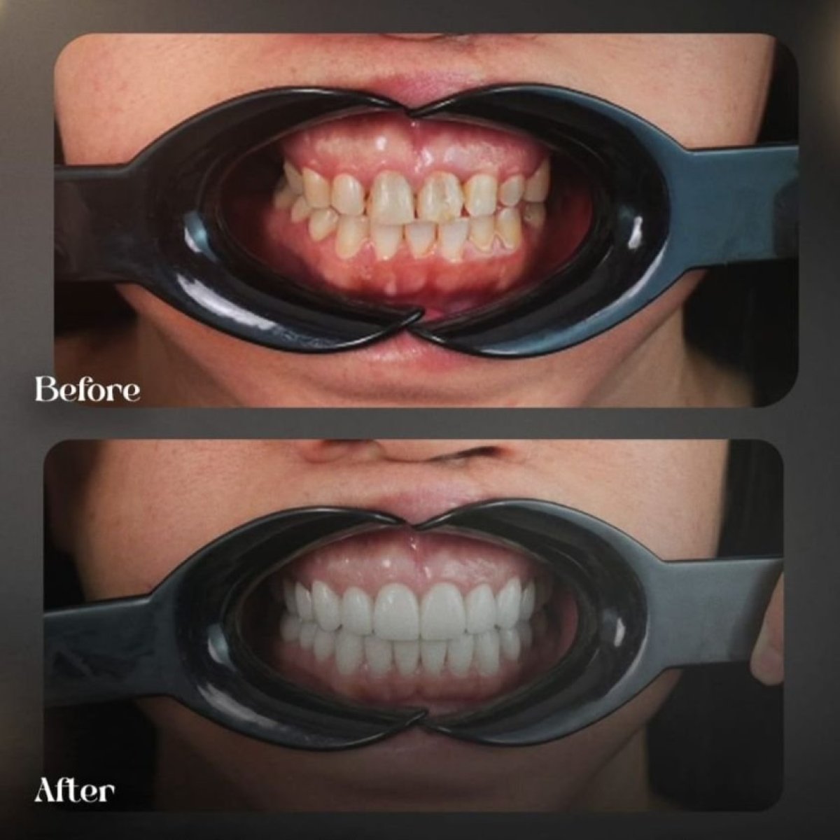 Результаты до и после Hollywood Smile в Grand Clinic – виниры для белых зубов