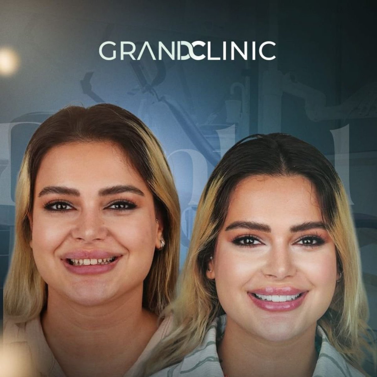 نتائج قبل وبعد ابتسامة هوليود في Grand Clinic – تحول واضح في الأسنان