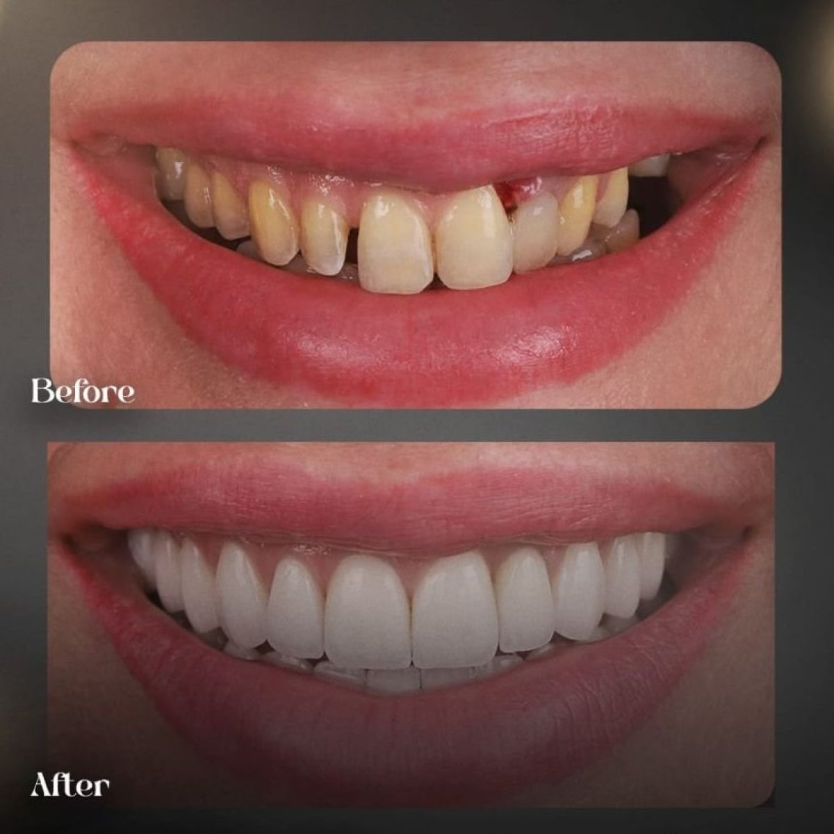 Resultados antes y después de Hollywood Smile en Grand Clinic – transformación con carillas