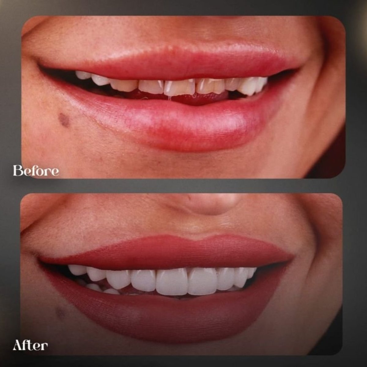 نتائج قبل وبعد ابتسامة هوليود في Grand Clinic – تحسين الابتسامة بالفينير