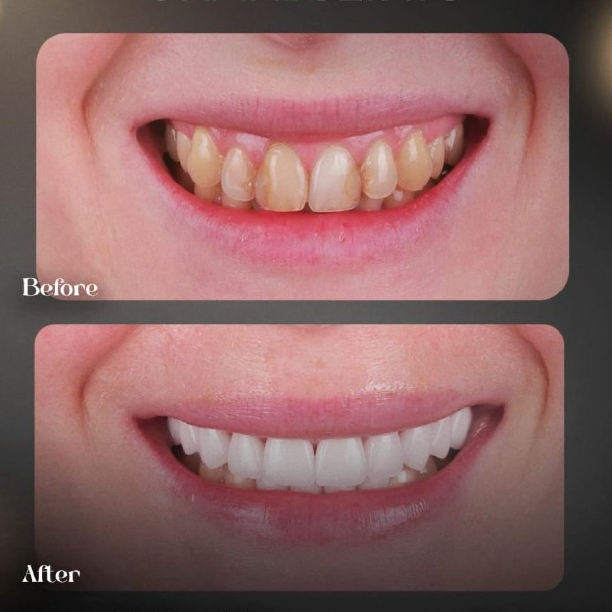 نتائج قبل وبعد ابتسامة هوليود في Grand Clinic – قشور الأسنان لأسنان أكثر بياضًا