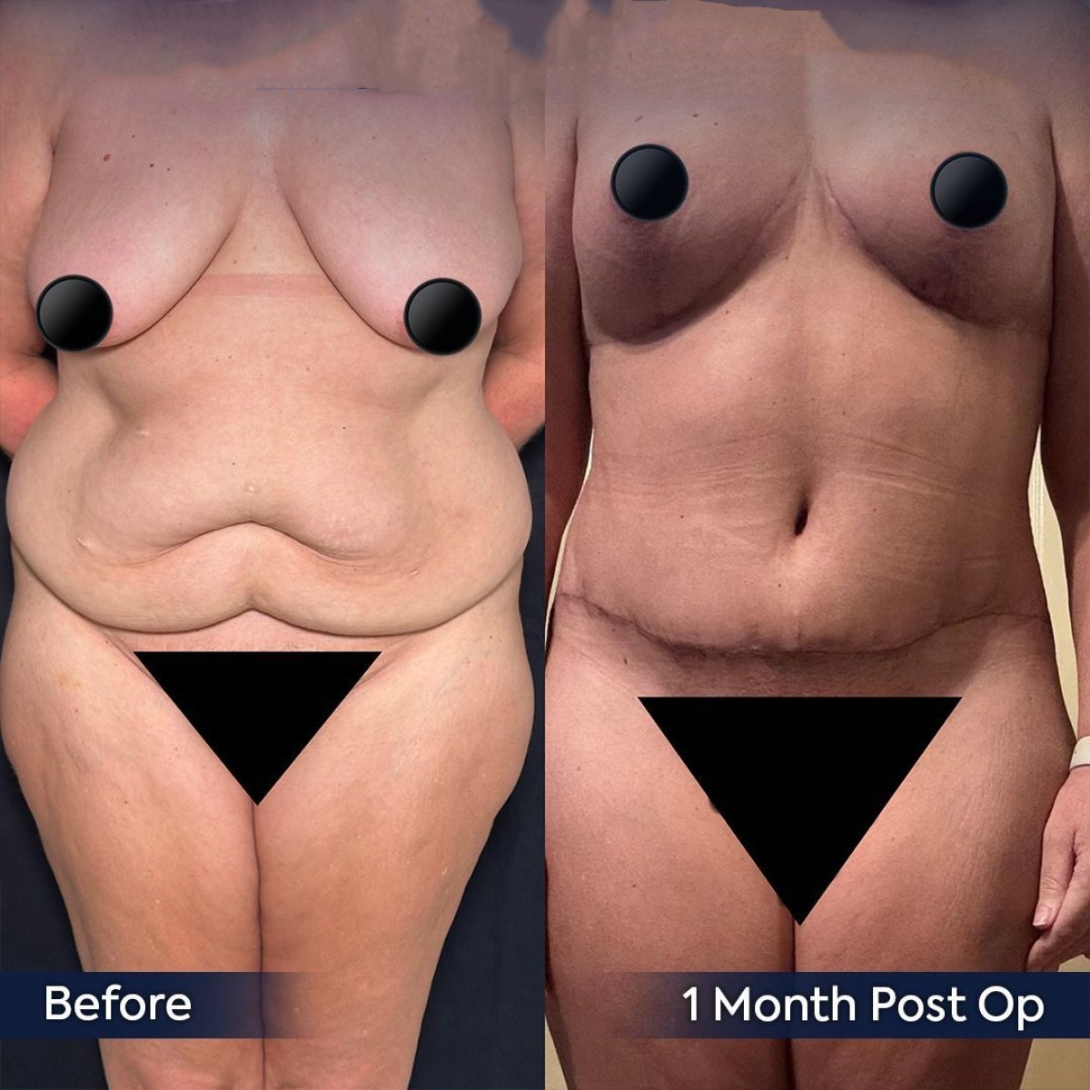 Before and after tummy tuck results at Dr. Safa Manav Clinic, improved abdominal contour