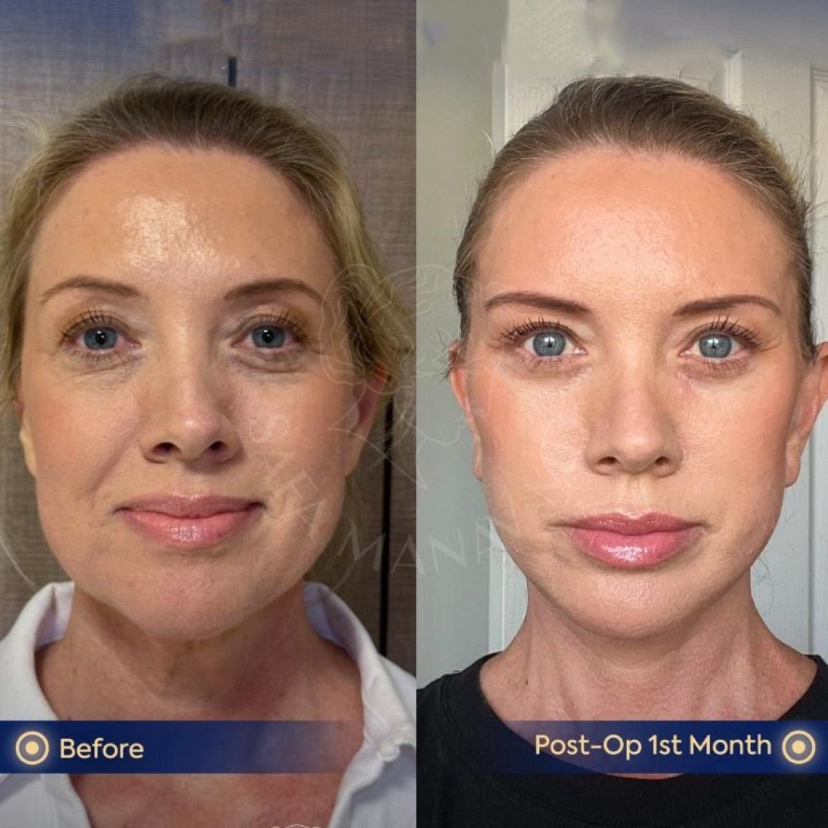 Resultados antes y después de Deep Plane Facelift en Dr. Safa Manav Clinic, rejuvenecimiento facial