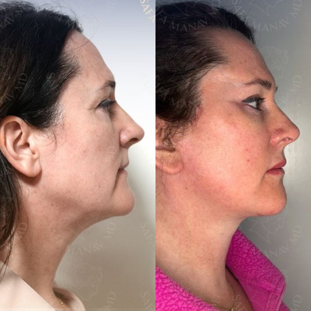 Resultados antes y después de deep plane facelift en Dr. Safa Manav Clinic, elevación visible