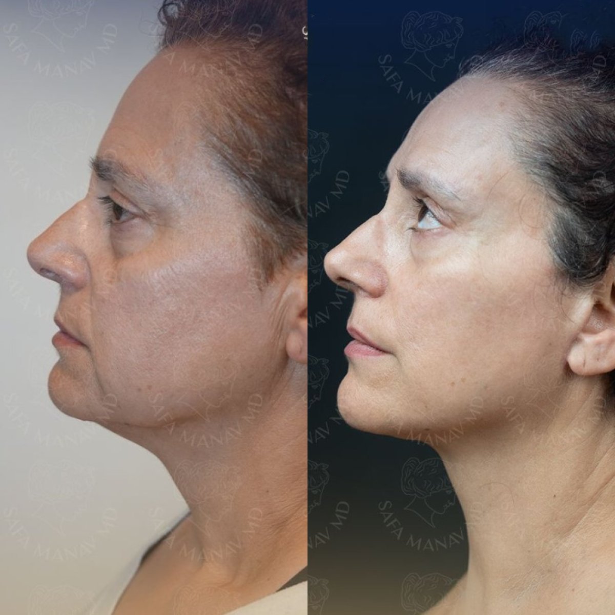 Resultados antes y después de deep plane facelift en Dr. Safa Manav Clinic, rejuvenecimiento facial