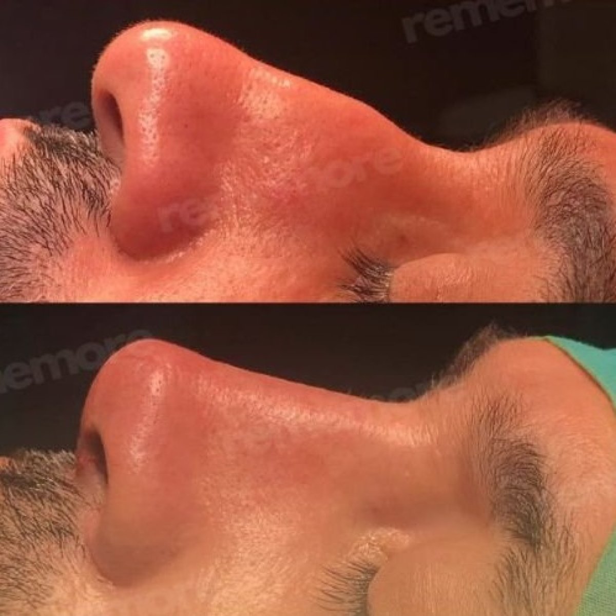 Before and after septoplasty results at Memorial Antalya Hospital for deviated septum correction