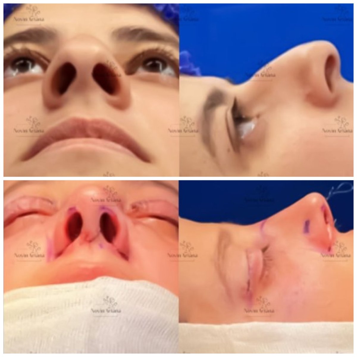 Resultados de rinoplastia antes y después en Novia Estetica, remodelación nasal