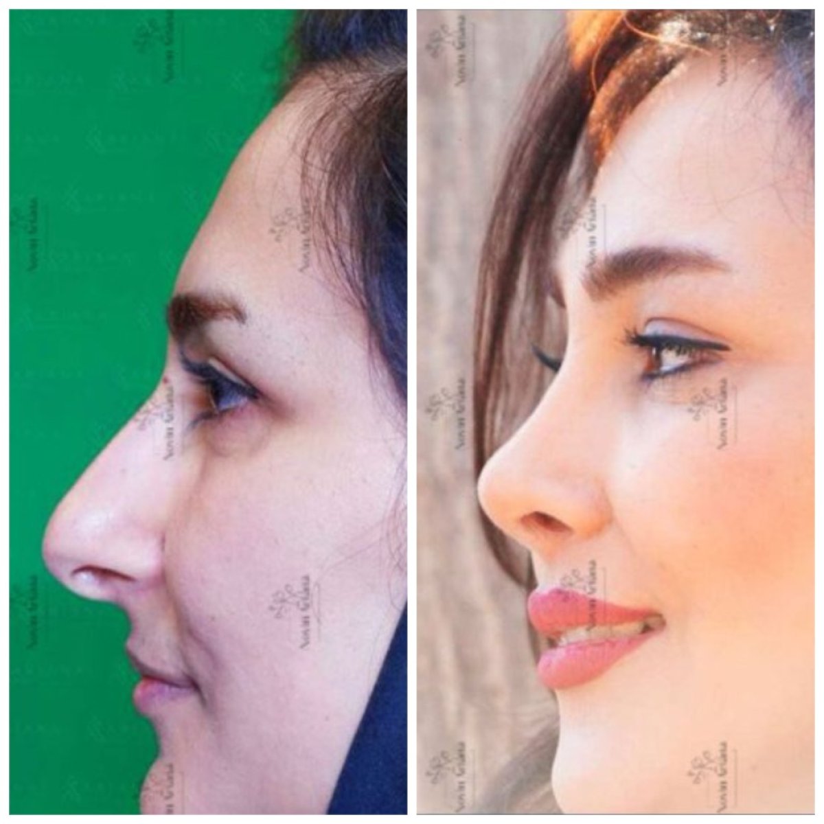 Resultados de rinoplastia antes y después, perfil mejorado tras cirugía en la clínica