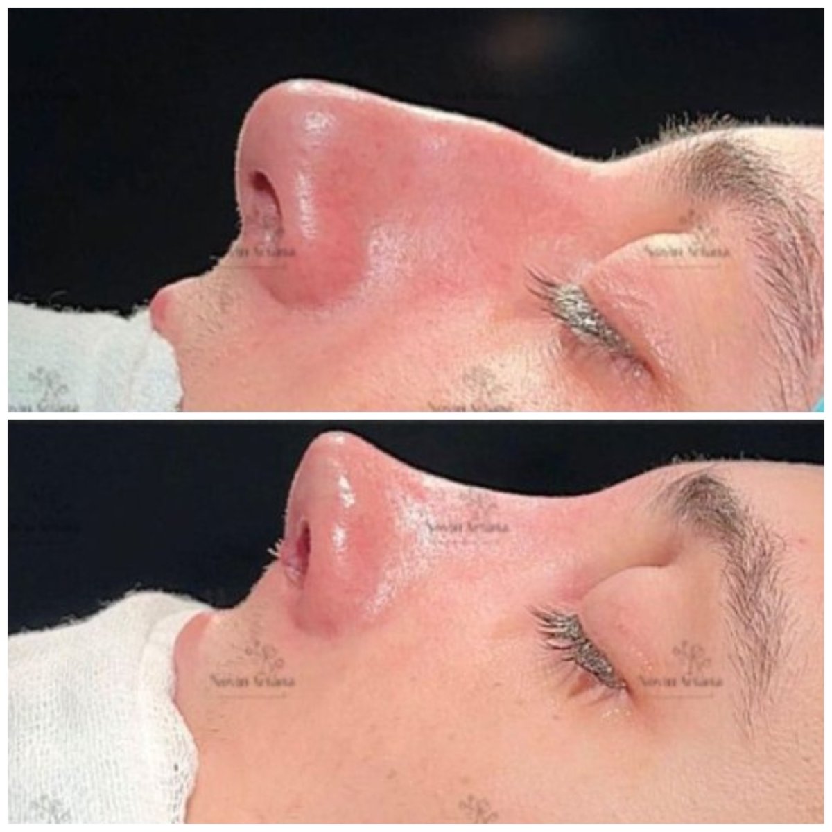 Resultados de rinoplastia antes y después, perfil y contorno nasal mejorados