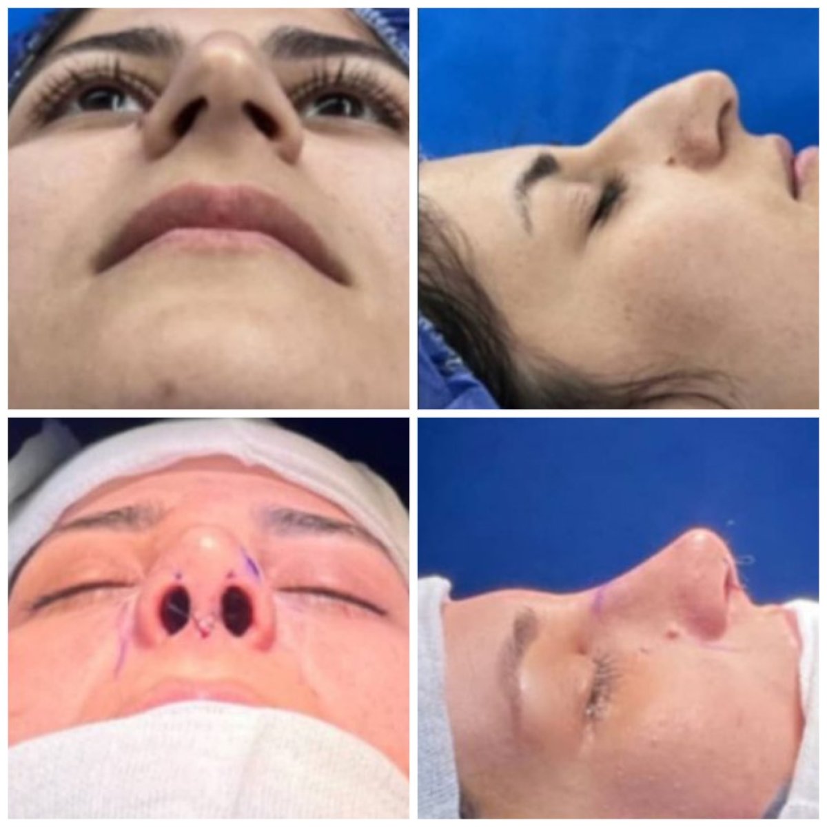 Resultados de rinoplastia antes y después, perfil nasal mejorado tras la cirugía