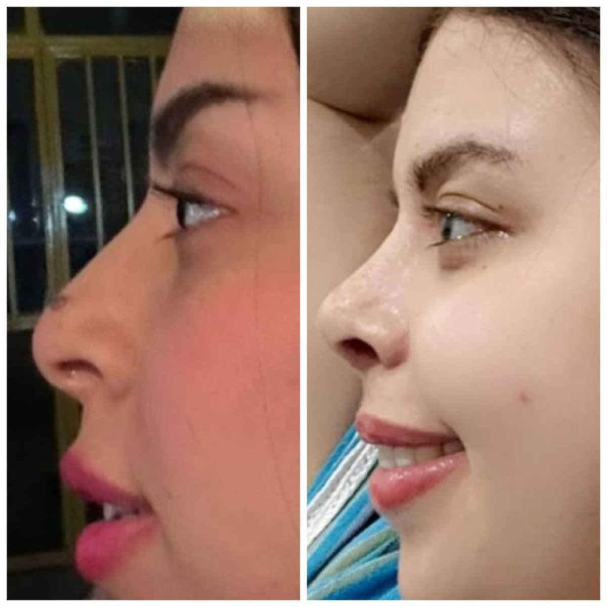 Resultados de rinoplastia antes y después, mejora de la forma y perfil nasal tras cirugía
