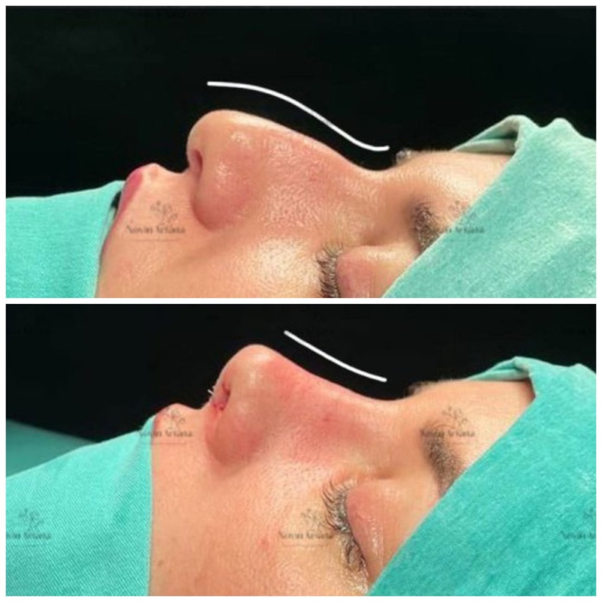 Résultats avant/après rhinoplastie chez Novia Estetica, profil nasal amélioré