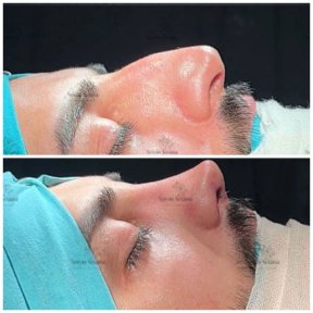 Simple Ultrasonic Rhinoplasty All Inclusive - photo 4