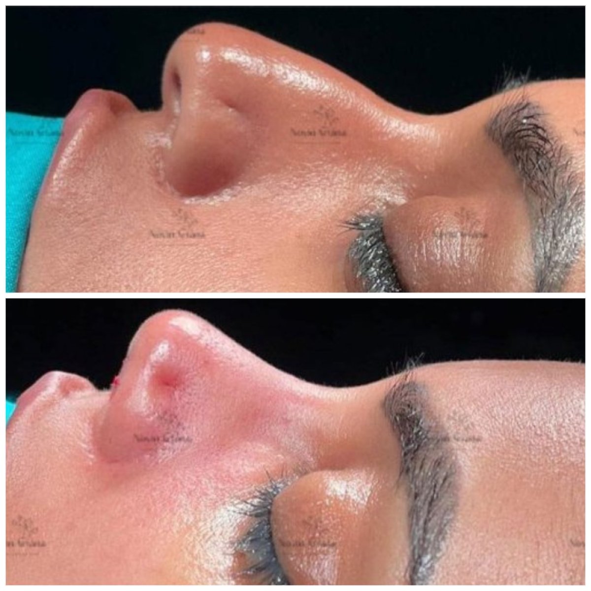 Résultats avant et après rhinoplastie, remodelage du nez et profil amélioré