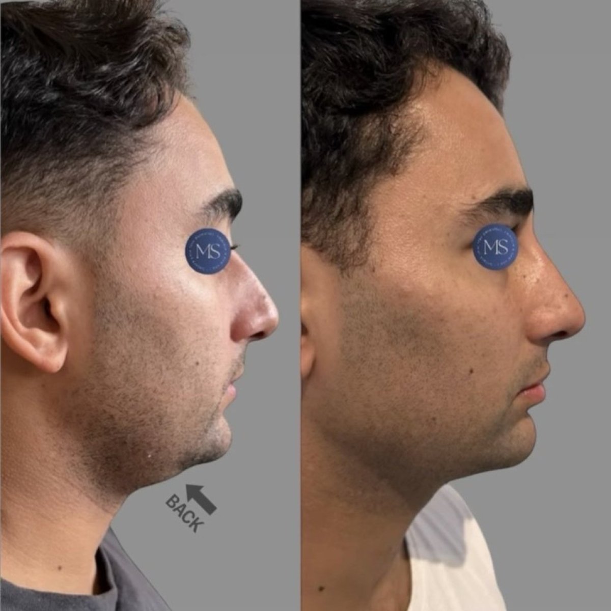 نتيجة قبل وبعد فيلر حمض الهيالورونيك لدى Dr. Michel Salameh – تحسين الذقن والفك