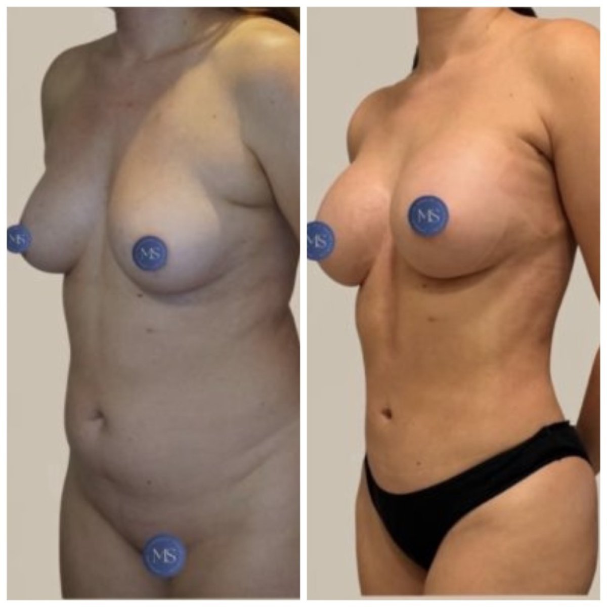 Before and after lipofilling results at Dr. Michel Salameh - Plastic And Aesthetic Surgery, body contour