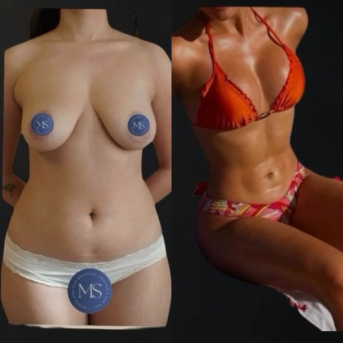 Resultados de lipofilling antes y después en Dr. Michel Salameh - Cirugía Plástica