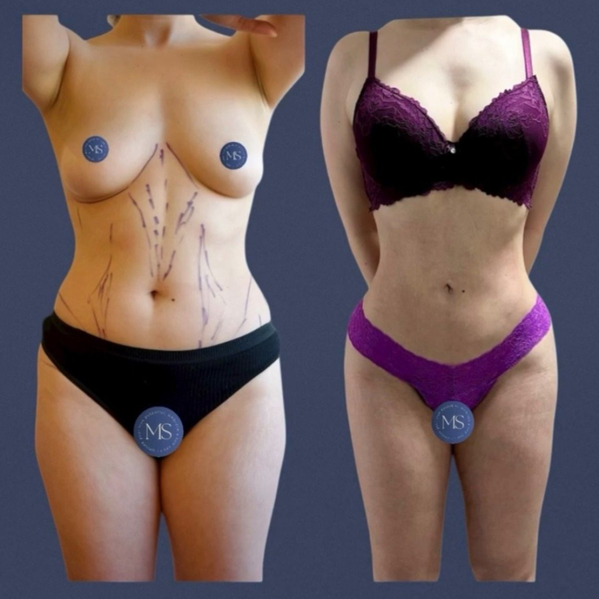 Vorher-nachher-Lipofilling-Ergebnisse bei Dr. Michel Salameh - Plastic And Aesthetic Surgery, Körperkontur