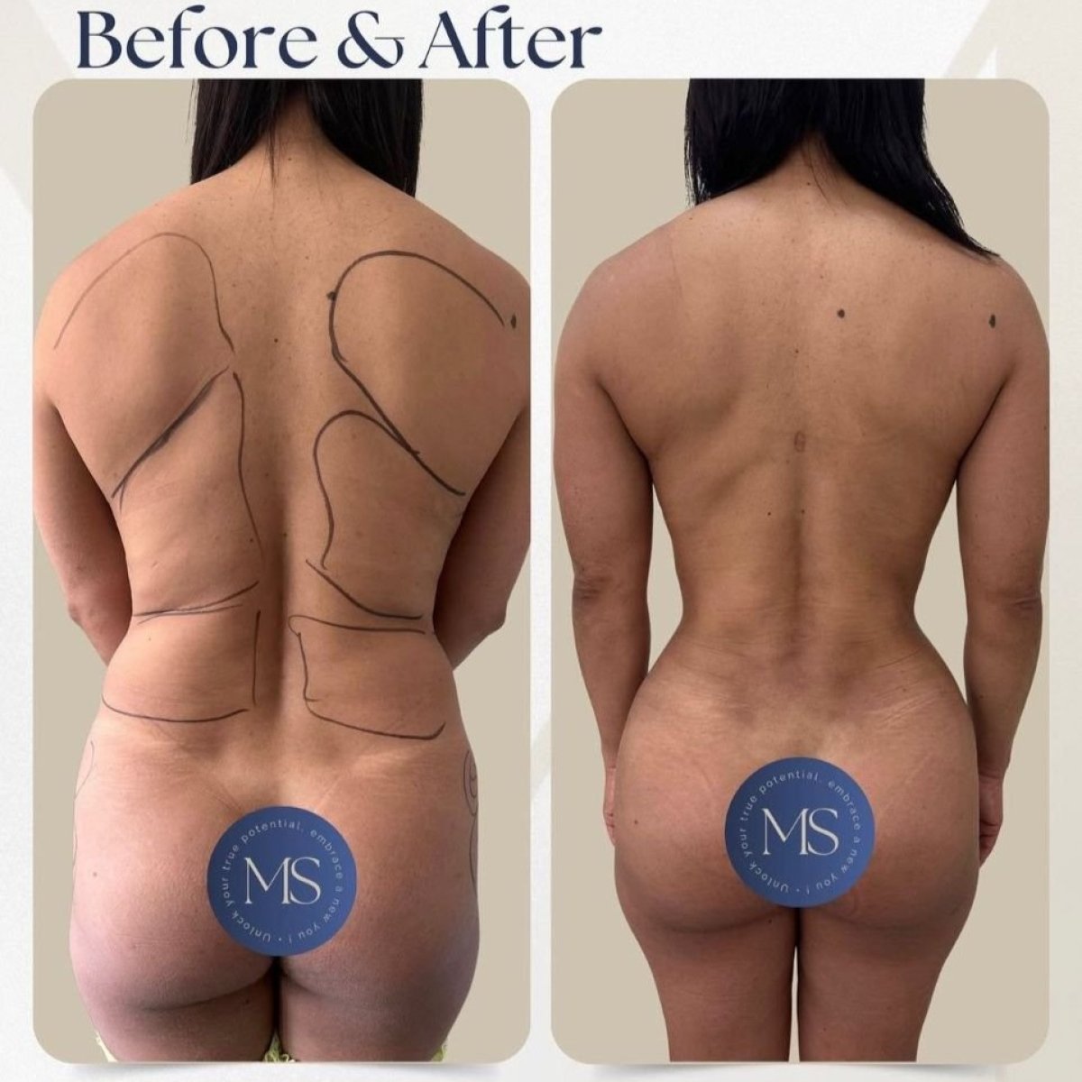 Before and after lipofilling results at Dr. Michel Salameh - Plastic And Aesthetic Surgery, back contour