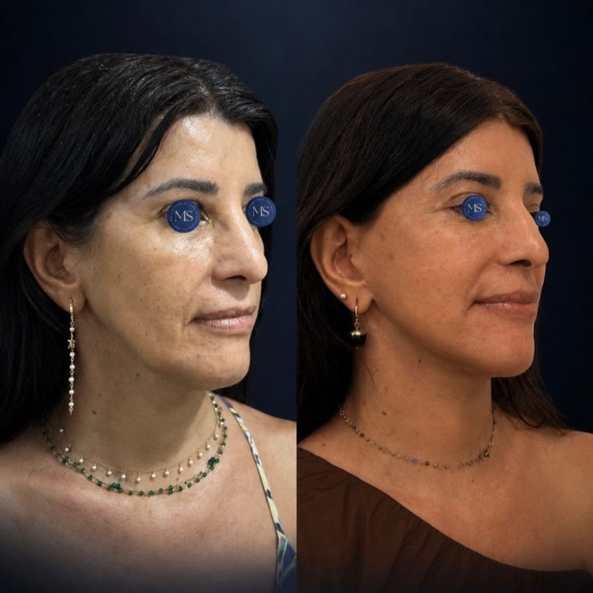 Результаты до и после фейслифтинга в клинике Dr. Michel Salameh - Plastic And Aesthetic Surgery