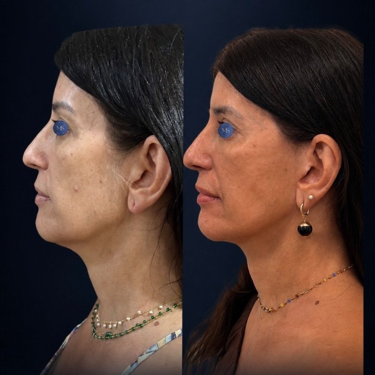 نتائج شد الوجه قبل وبعد في عيادة Dr. Michel Salameh - Plastic And Aesthetic Surgery