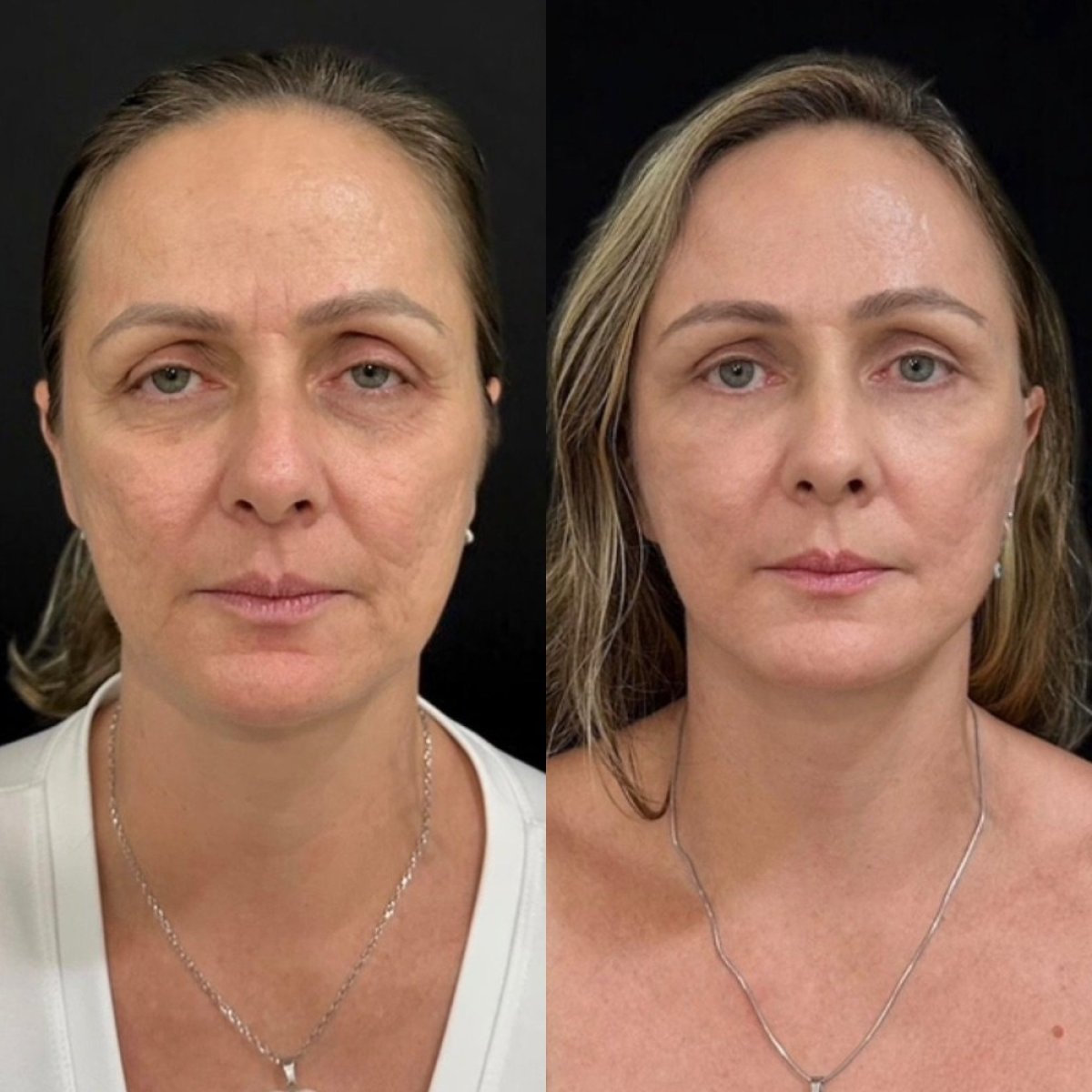 Результати до і після підтяжки обличчя в клініці Dr. Michel Salameh - Plastic And Aesthetic Surgery