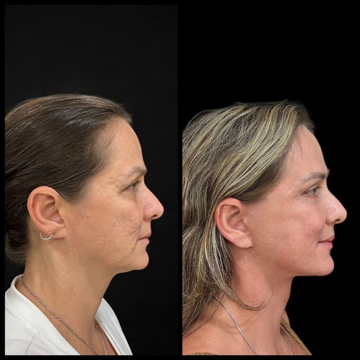 Résultats lifting visage avant/après chez Dr. Michel Salameh - Chirurgie esthétique