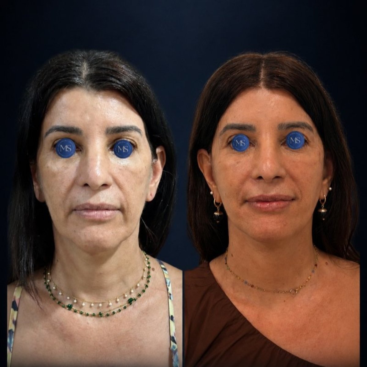 Résultats avant/après lifting deep plane chez Dr. Michel Salameh - Plastic And Aesthetic Surgery